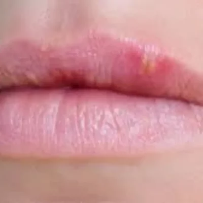 White Bumps on Lips Causes, Treatment, and Prevention